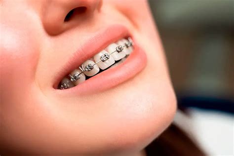 precio de brackets metalicos en argentina|cuanto cuestan los brackets.